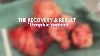 Massive Fibroid Tumors | Recovery & Results