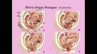 Pelvic Organ Prolapse - CRASH! Medical Review Series