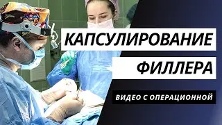 КАПСУЛИРОВАНИЕ ФИЛЛЕРА | ПОДТЯЖКА СРЕДНЕЙ ЗОНЫ ЛИЦА | ПЛАСТИКА НИЖНИХ ВЕК | ВИДЕО С ОПЕРАЦИИ