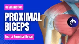 Proximal Biceps Tear and Biceps Tenodesis: Restoring Function and Relieving Pain - 3D Animation