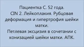 Конизация и петлевая Эксцизия  шейки матки. Рубцовая деформация. CIN2. Лейкоплакия.