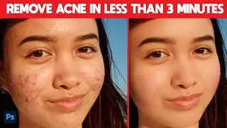 Get Rid of Acne Really Fast! | This actually works in real-life (photoshop)