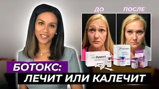 BOTOX //Как убрать морщины лба, морщины межбровья и "гусиные лапки" // Ботокс от морщин: за и против