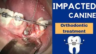 IMPACTED CANINE exposure treatment with ORTHODONTICS and braces - Step by step