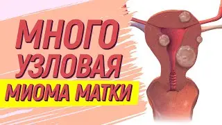 Многоузловая миома матки 😬 Удалить нельзя лечить😳