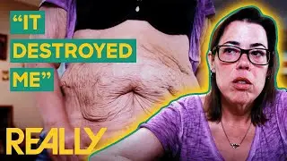 Transforming Lives: Natasha Overcomes Her Body Shame After Excess Skin Loss | My Extreme Excess Skin