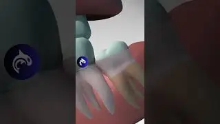 Wisdom Teeth: See Why and How They're Removed 