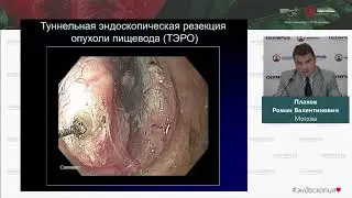 Туннельные эндоскопические операции на пищеводе и желудке