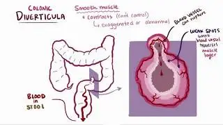 Difference Between Colitis and Diverticulitis