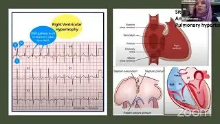 ECG in Congenital Heart Disease (Lecture 81)