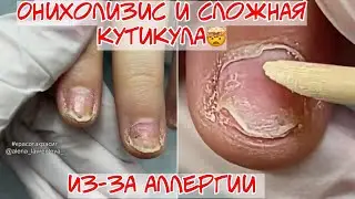 Аллергия на гель лак 🥴 Онихолизис 😱Сложная кутикула