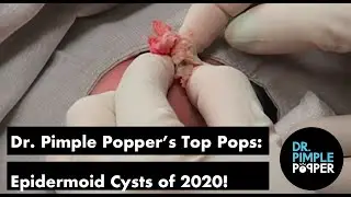 Dr. Pimple Popper's Top Pops of 2020: Epidermoid Cysts!