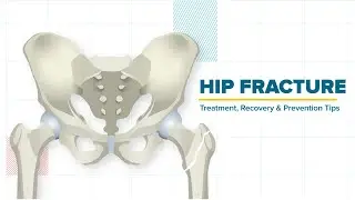 Hip Fracture - Treatment, Recovery & Prevention Tips