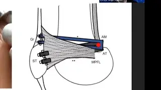 MPFL and MQTFL Reconstruction- A New Technique