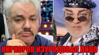 Шок! Киркоров изуродовал лицо неудачной операцией