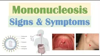 Infectious Mononucleosis (Mono) Signs & Symptoms