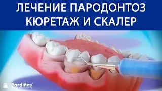 Лечение пародонтоз — Кюретаж и скалер ©