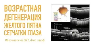 Возрастная дегенерация желтого пятна сетчатки глаза