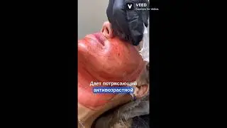 Об этой процедуре молчат специально:супер эффект- низкая цена! #морщины #омоложение #пилинг #ботокс