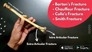 Colles Fracture, Smith Fracture, Bartons Fracture, Chauffeur Fracture | Orthopedics Lecture | TCML