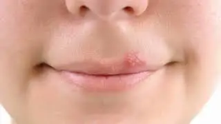 Difference Between Cold Sore and Fever Blister