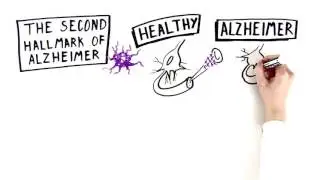 Alzheimers Disease: The Basics | Being Patient