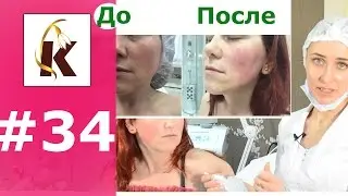 Нити с насечками для подтяжки лица, До и ПОСЛЕ, очень эффективный метод