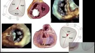 Echocardiographic assessment of the tricuspid valve - Dr Lisa Walters