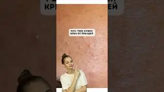 Замучили ПРЫЩИ? Попробуй Крем от прыщей, комедонов и черных точек(Арт.Wb: 154859673) 