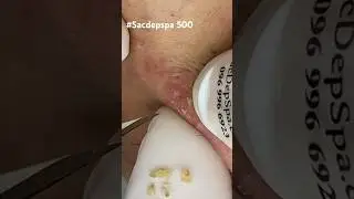 Full video: Sacdepspa 500☝️ #sacdepspa #acne #treatments #relaxing