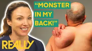 1.2-Kilo Lipoma DANGLES From Man's Back! | The Bad Skin Clinic