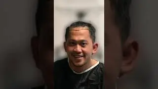 Estrada solusi nya untuk tanam rambut !!