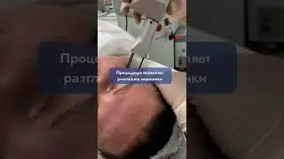 Лазерная шлифовка (Фракционный фототермолиз) #shortvideo #омоложение #косметология #обнинск