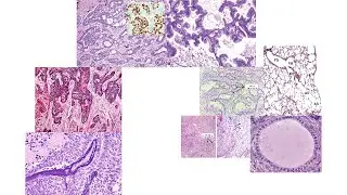 Lung adenocarcinoma histology