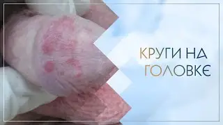 💣 Круги на головке. Клинический случай №31