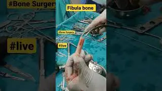 Fibula Bone Graft | 