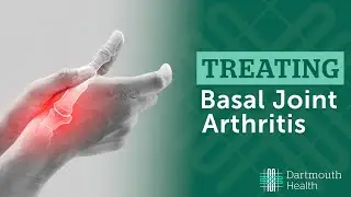 Basal Joint Arthritis