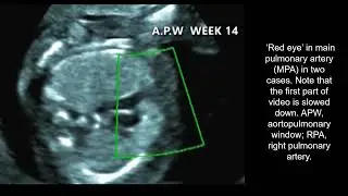 New #UOGJournal videoclip on the early prenatal diagnosis of aortopulmonary window