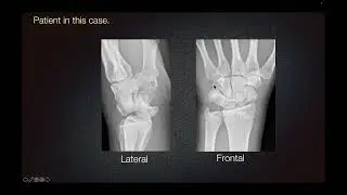 Sports Medicine Case 17: 17-year-old: High Energy Wrist Trauma