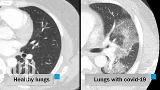 How covid-19 attacks the lungs