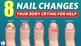 Nail signs of Disease | Nail pitting | Finger clubbing | Signs of anemia | Terry's nails