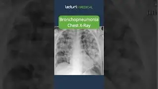 Understanding Bronchopneumonia 🫁 #MedicalEducation #usmle