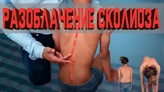 Что такое сколиоз?