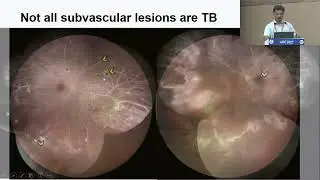 AIOC2022   IC5   Topic   Dr Soumyava Basu Retinal vasculitis – non infectious versus infectious how
