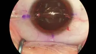 ICL Insertion