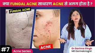 Fungal Acne Kya Hota Hai? | Fungal Acne का इलाज | फंगल एक्ने कैसे ठीक करें ? | Dermatologist