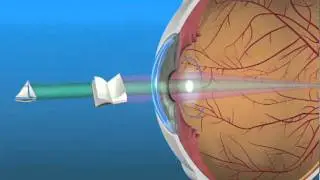 Multifocal Lens (IOL)