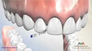 Interproximal Reduction or IPR - Polishing Strip