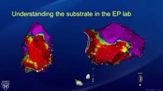 Ablation: Treatment for Ventricular Tachycardia - Part 2