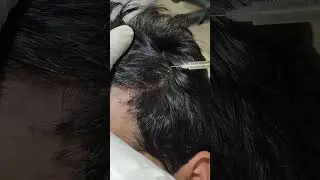 #shortvideo #hair #prp #prphairtreatment #hairlossprevention